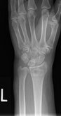 Wrist Fracture